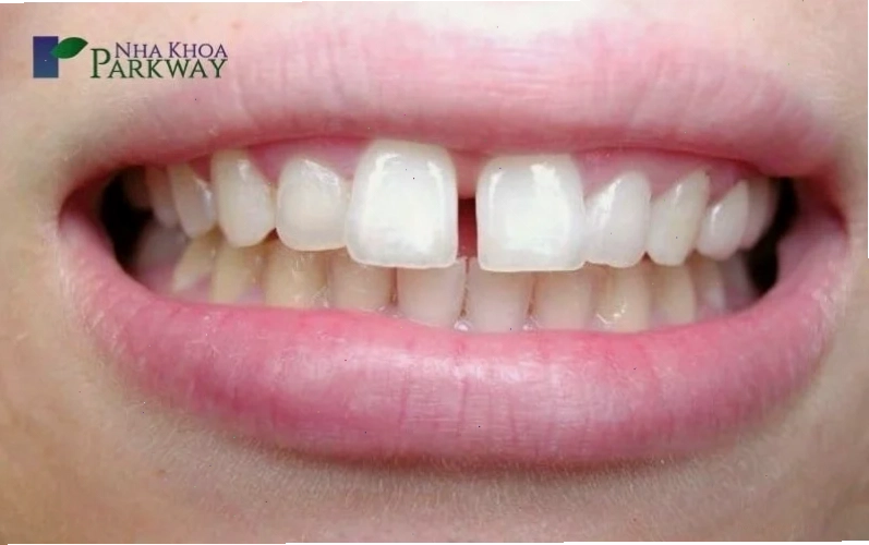 con gái có răng cửa to chăm sóc răng miệng