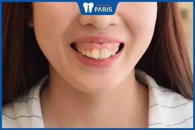 con gái có răng cửa to chụp hình