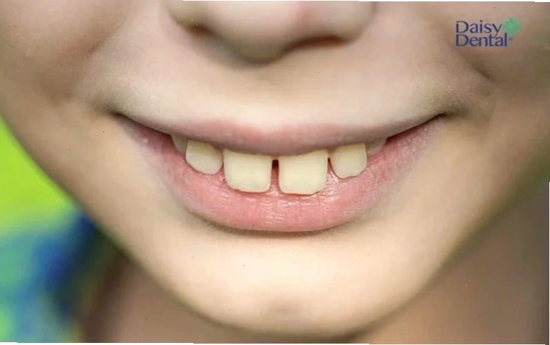 con gái có răng cửa to cuốn hút