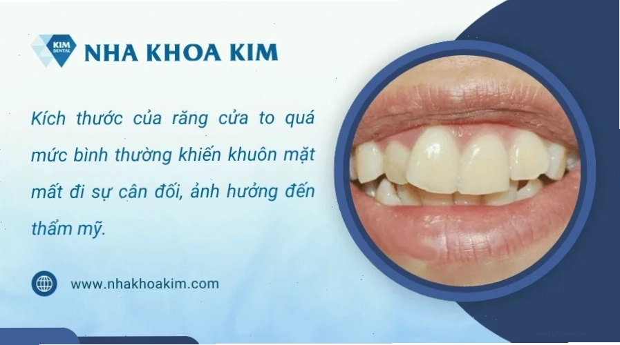 con gái có răng cửa to phong thái