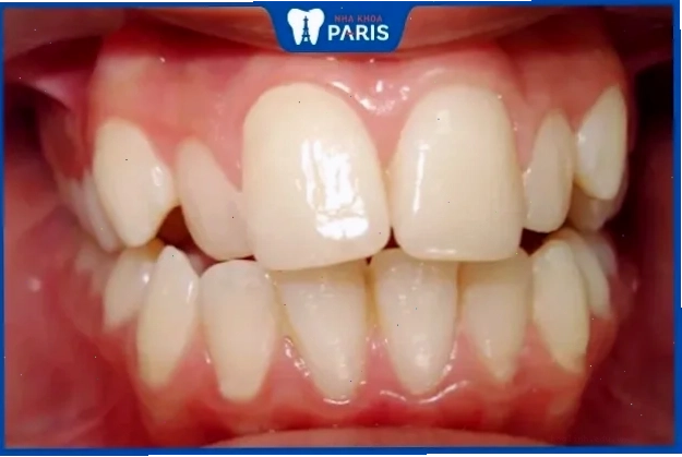 con gái có răng cửa to rạng ngời