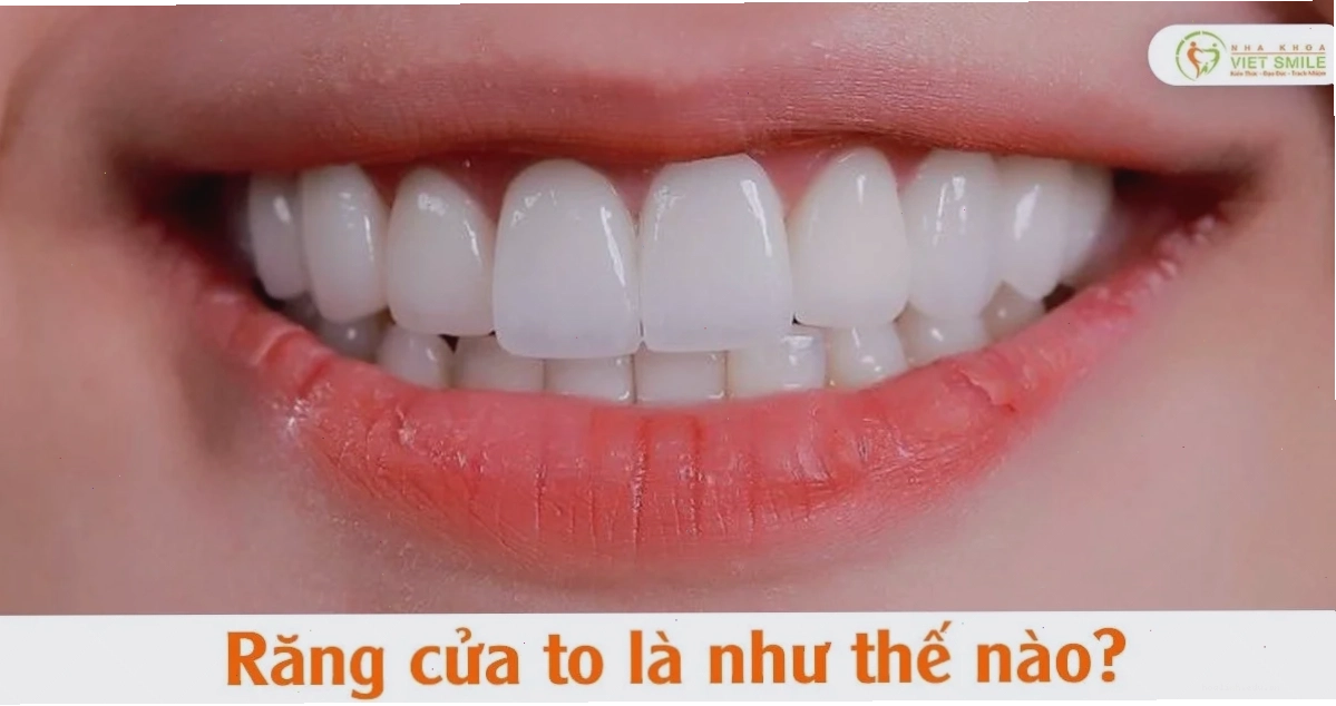 con gái có răng cửa to xinh đẹp