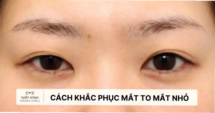 con gái mắt to lồi trong cuộc sống