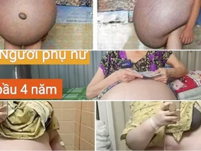 Sự thật về cô gái bụng to và nguy cơ sức khỏe tiềm ẩn