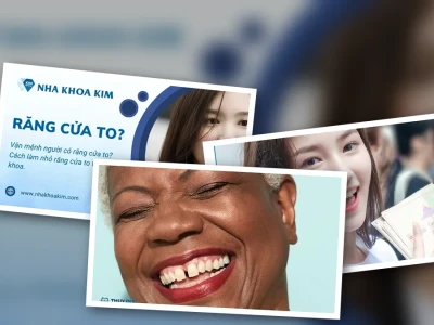 Sự thật về vận mệnh con gái có răng cửa to